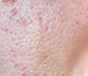 ACNE GEL (SERUM)