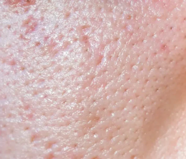 vettehuud (1) ACNE GEL (SERUM)